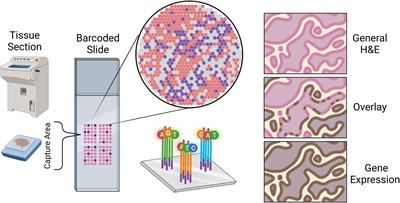 Spatial transcriptomics in glioblastoma: is knowing the right zip code the key to the next therapeutic breakthrough?